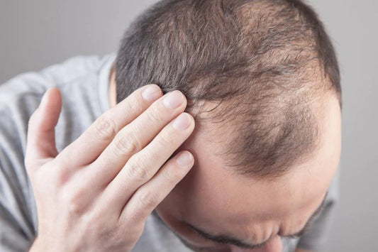 "Unlocking the Secrets of Hair Loss: The Testosterone and Genetics Connection"
